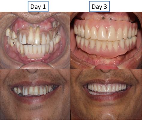 permanent dentures replacement